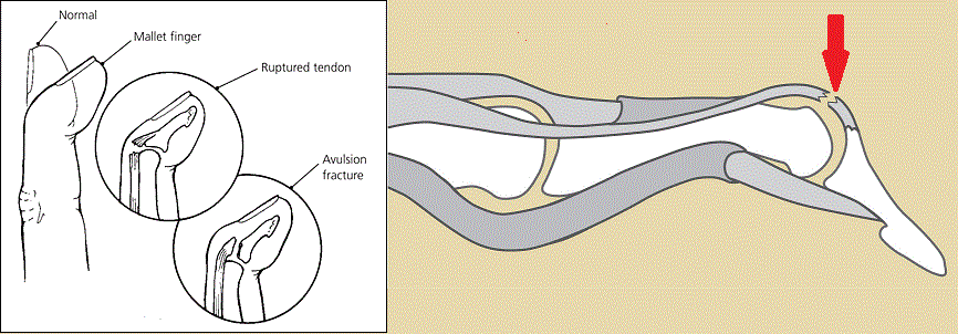 mallet finger