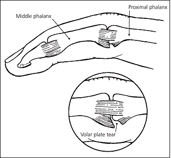 volar plate injury